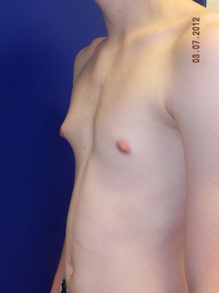 before gynecomastia surgery