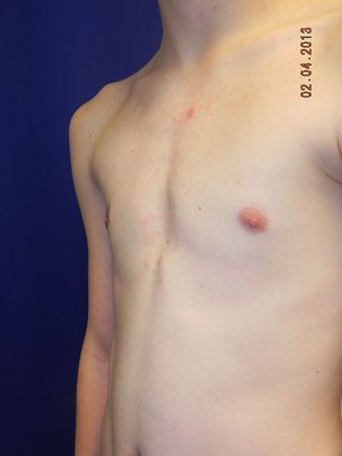 after gynecomastia surgery