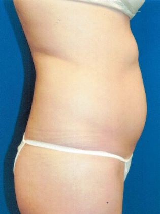 Case 9 before liposuction