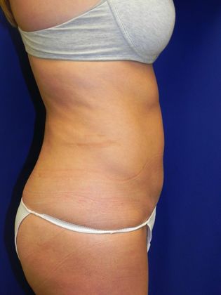Case 9 after liposuction